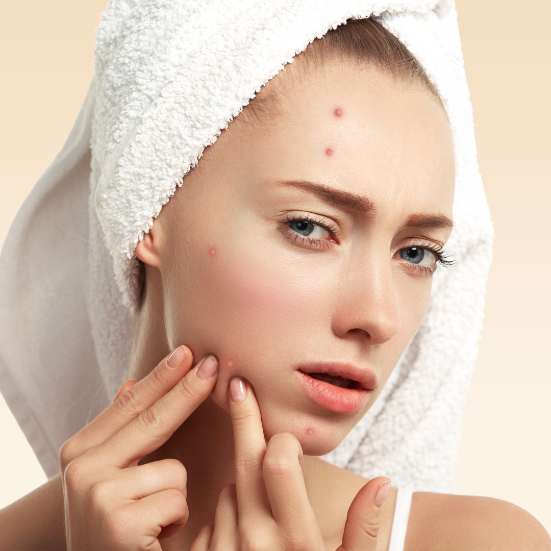 How To Get Rid Of Acne Marks